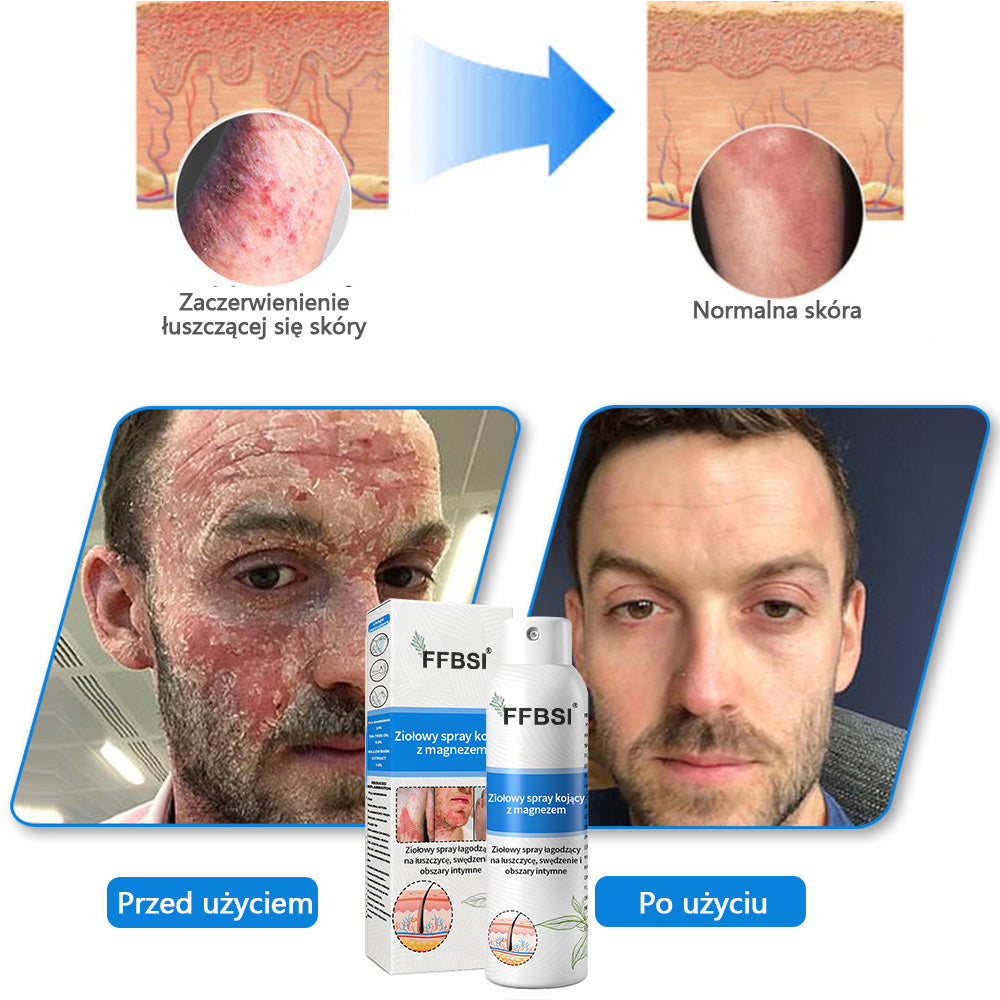 Szybka ulga w swędzeniu i ukojenie zaczerwienionej skóry! ⭐FFBSI® Magnezowy spray ziołowy na łuszczycę 🔥Łagodzi objawy łuszczycy, egzemy i trądziku, zmniejsza wypryski i przebarwienia, głęboko nawilża i wspiera regenerację skóry