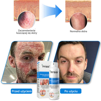 Szybka ulga w swędzeniu i ukojenie zaczerwienionej skóry! ⭐FFBSI® Magnezowy spray ziołowy na łuszczycę 🔥Łagodzi objawy łuszczycy, egzemy i trądziku, zmniejsza wypryski i przebarwienia, głęboko nawilża i wspiera regenerację skóry