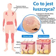 Szybka ulga w swędzeniu i ukojenie zaczerwienionej skóry! ⭐FFBSI® Magnezowy spray ziołowy na łuszczycę 🔥Łagodzi objawy łuszczycy, egzemy i trądziku, zmniejsza wypryski i przebarwienia, głęboko nawilża i wspiera regenerację skóry