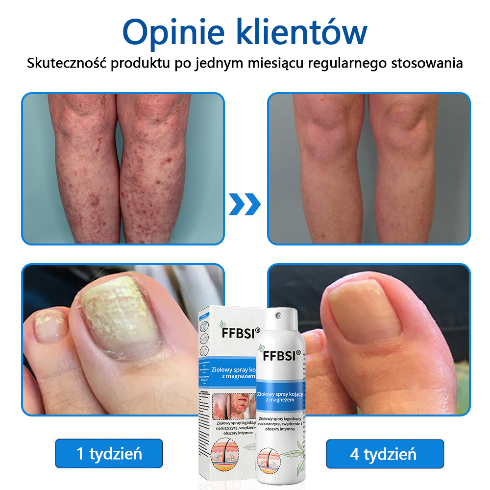 Szybka ulga w swędzeniu i ukojenie zaczerwienionej skóry! ⭐FFBSI® Magnezowy spray ziołowy na łuszczycę 🔥Łagodzi objawy łuszczycy, egzemy i trądziku, zmniejsza wypryski i przebarwienia, głęboko nawilża i wspiera regenerację skóry