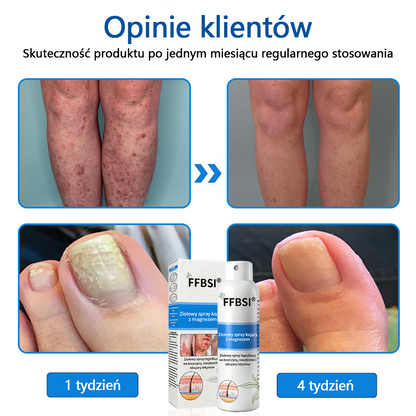 Szybka ulga w swędzeniu i ukojenie zaczerwienionej skóry! ⭐FFBSI® Magnezowy spray ziołowy na łuszczycę 🔥Łagodzi objawy łuszczycy, egzemy i trądziku, zmniejsza wypryski i przebarwienia, głęboko nawilża i wspiera regenerację skóry