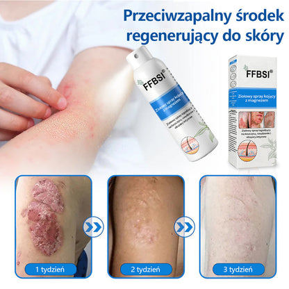 Szybka ulga w swędzeniu i ukojenie zaczerwienionej skóry! ⭐FFBSI® Magnezowy spray ziołowy na łuszczycę 🔥Łagodzi objawy łuszczycy, egzemy i trądziku, zmniejsza wypryski i przebarwienia, głęboko nawilża i wspiera regenerację skóry