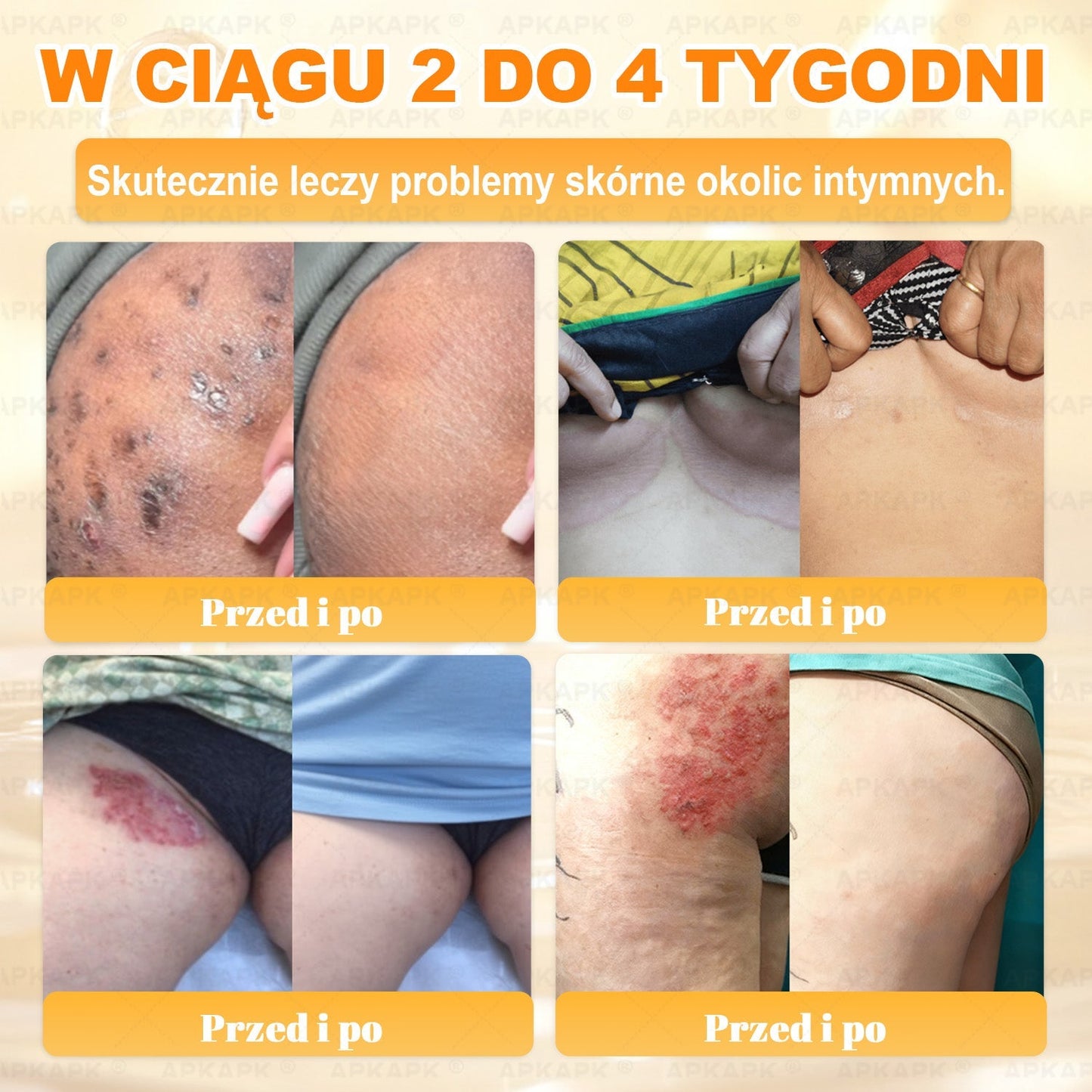 ΑPΚΑPK® Jad Pszczoły Kompleksowy Krem✨✨pomaga w leczeniu problemów skórnych, takich jak: zmarszczki, blizny, plamy pigmentacyjne, rozstępy, trądzik, łuszczyca, egzema, zmiany skórne, podrażnienia, stany zapalne i inne problemy skórne🔥